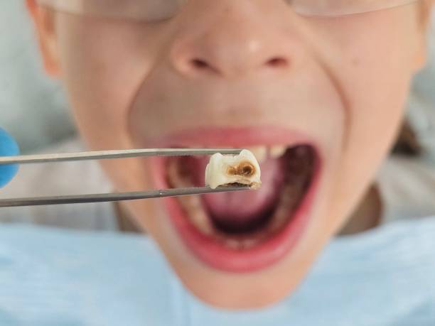 Best Emergency Tooth Extraction in New London, OH